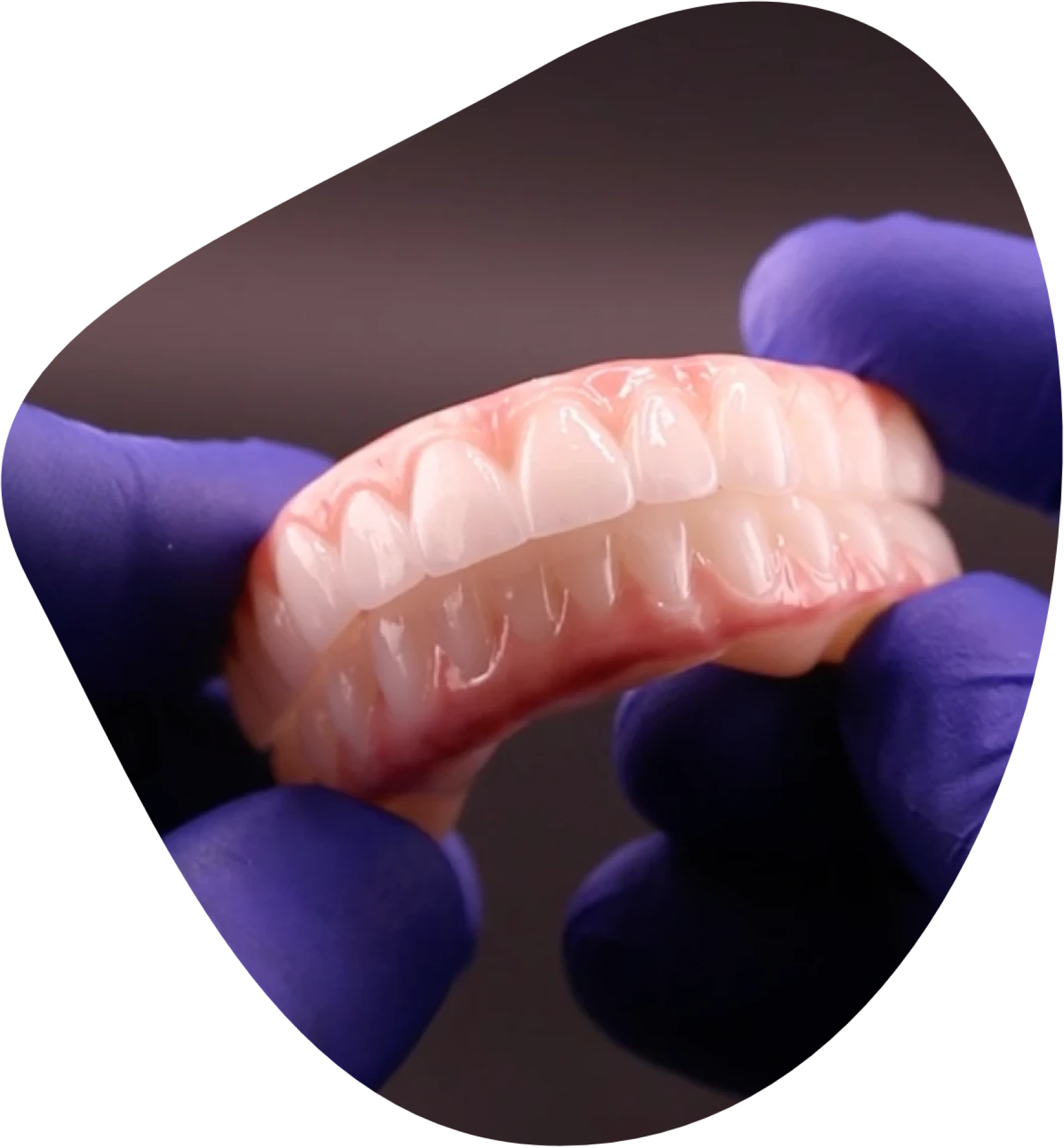 Photo of All-On-4 dental implant bridges.