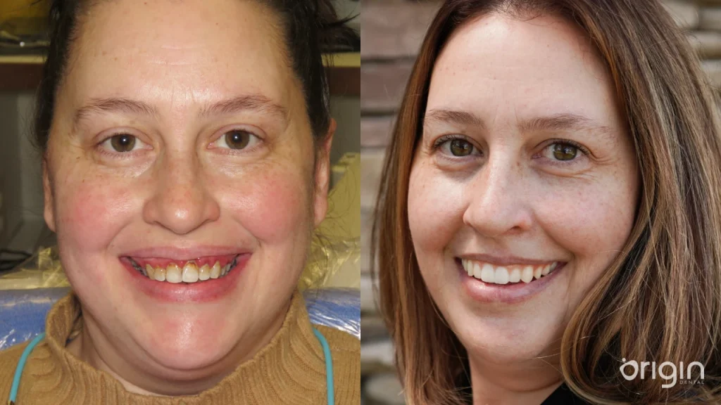 Before and after full mouth dental implants in Atlanta at Origin Dental Implant Studio.