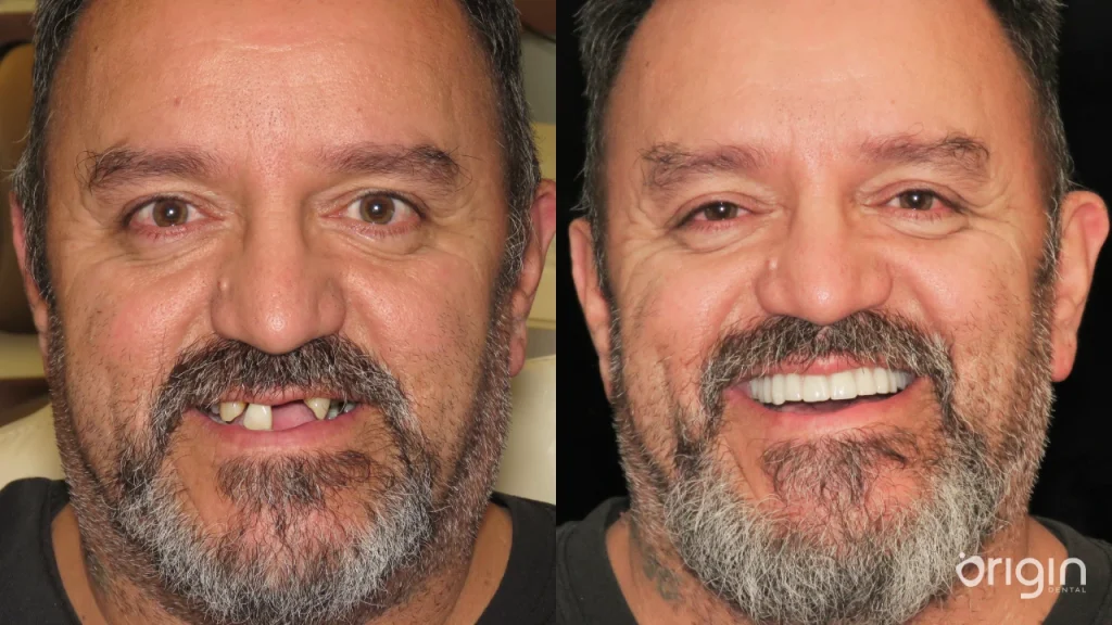 Before and after full mouth dental implants in Atlanta at Origin Dental Implant Studio.